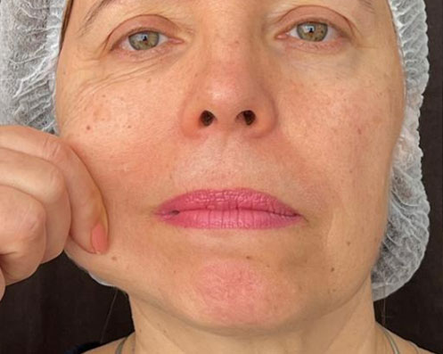 Antes - Bioestimuladores